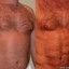 Surgery for a Six-Pack 3