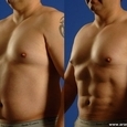 Surgery for a Six-Pack