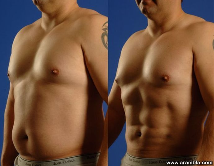 Surgery for a Six-Pack