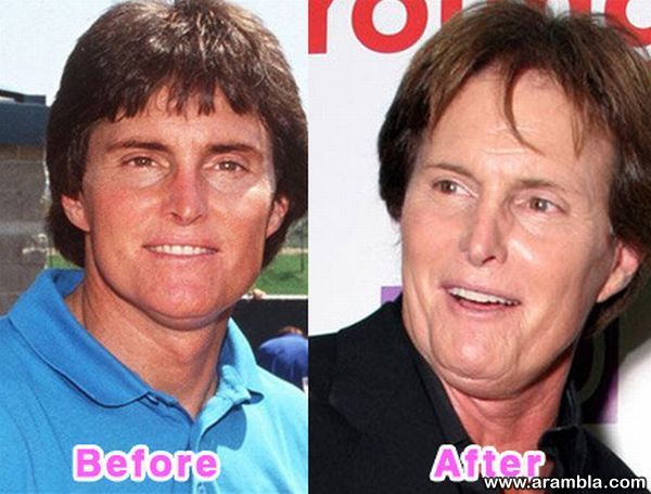 Celebrity Plastic Surgery Disasters